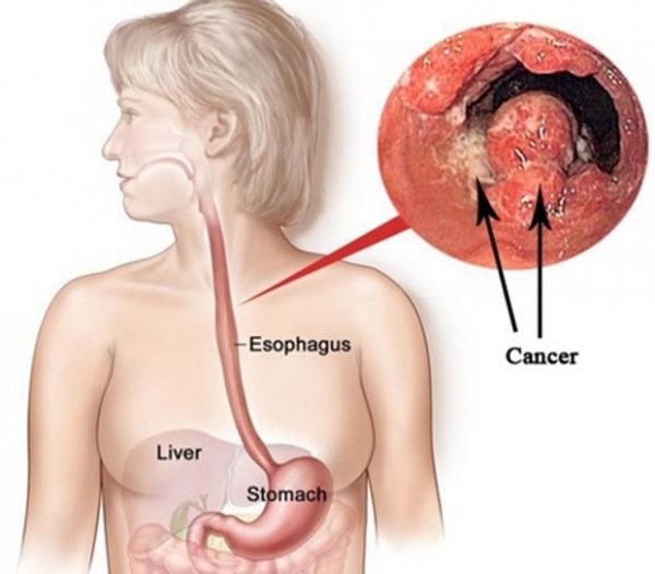 Ảnh 5 của Esophageal cancer